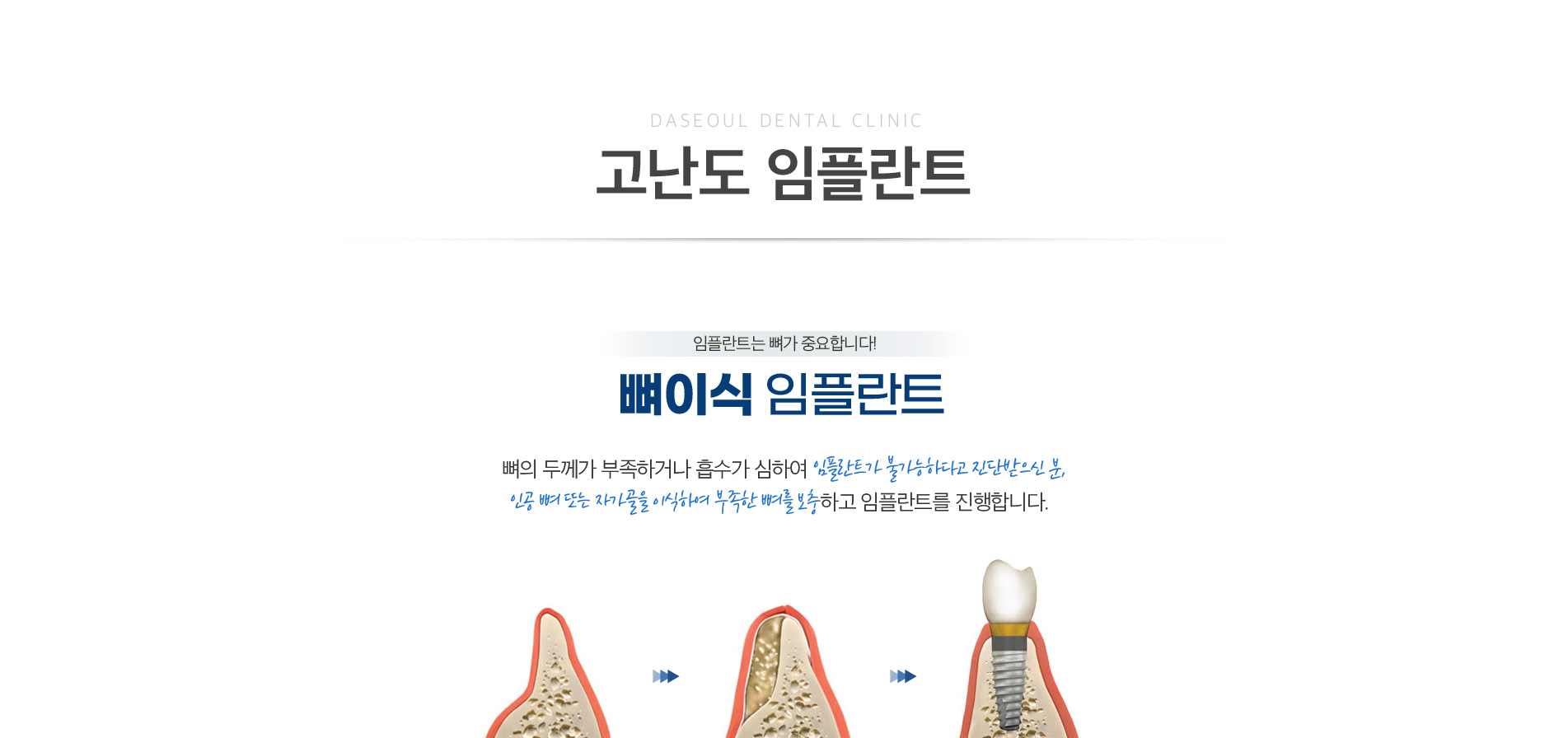 고난도 임플란트