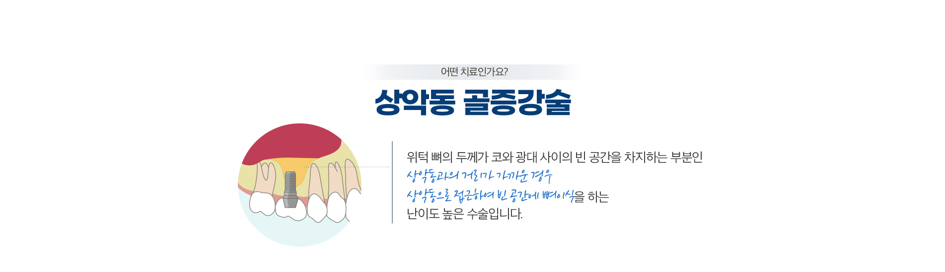 상악동 골증강술