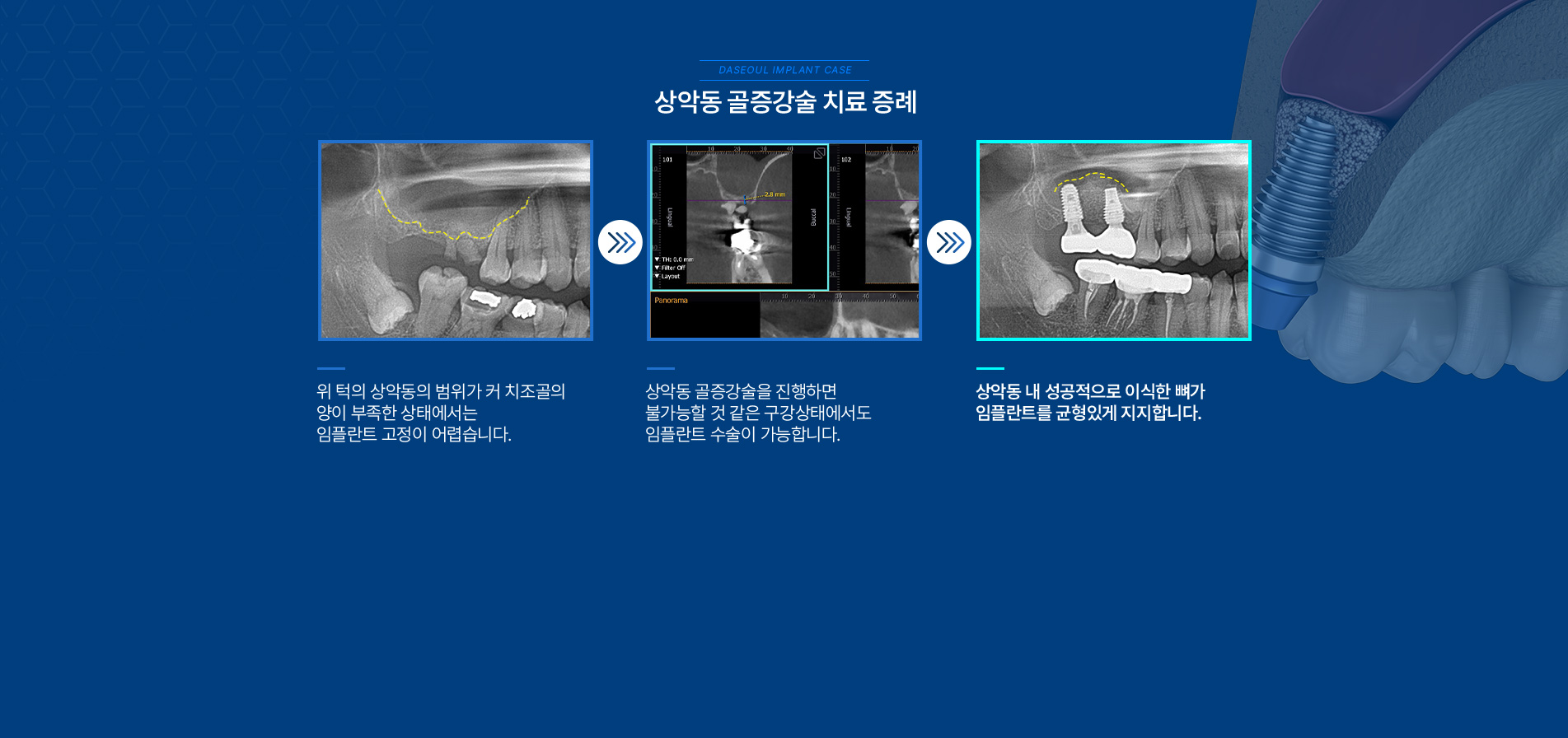 상악동 골증강술 치료 증례