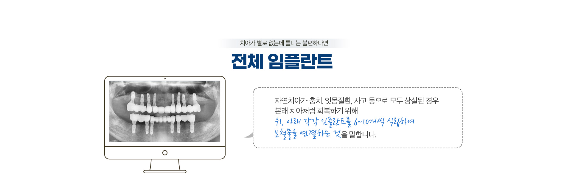 전체 임플란트
