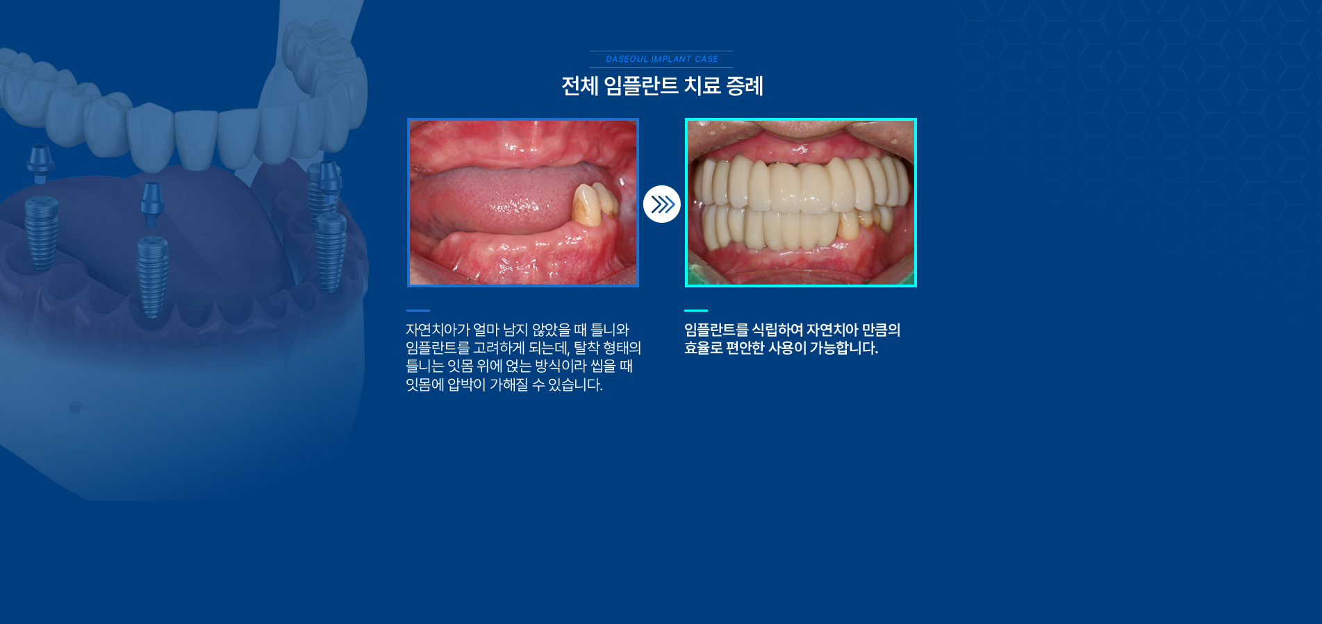전체 임플란트 치료 증례