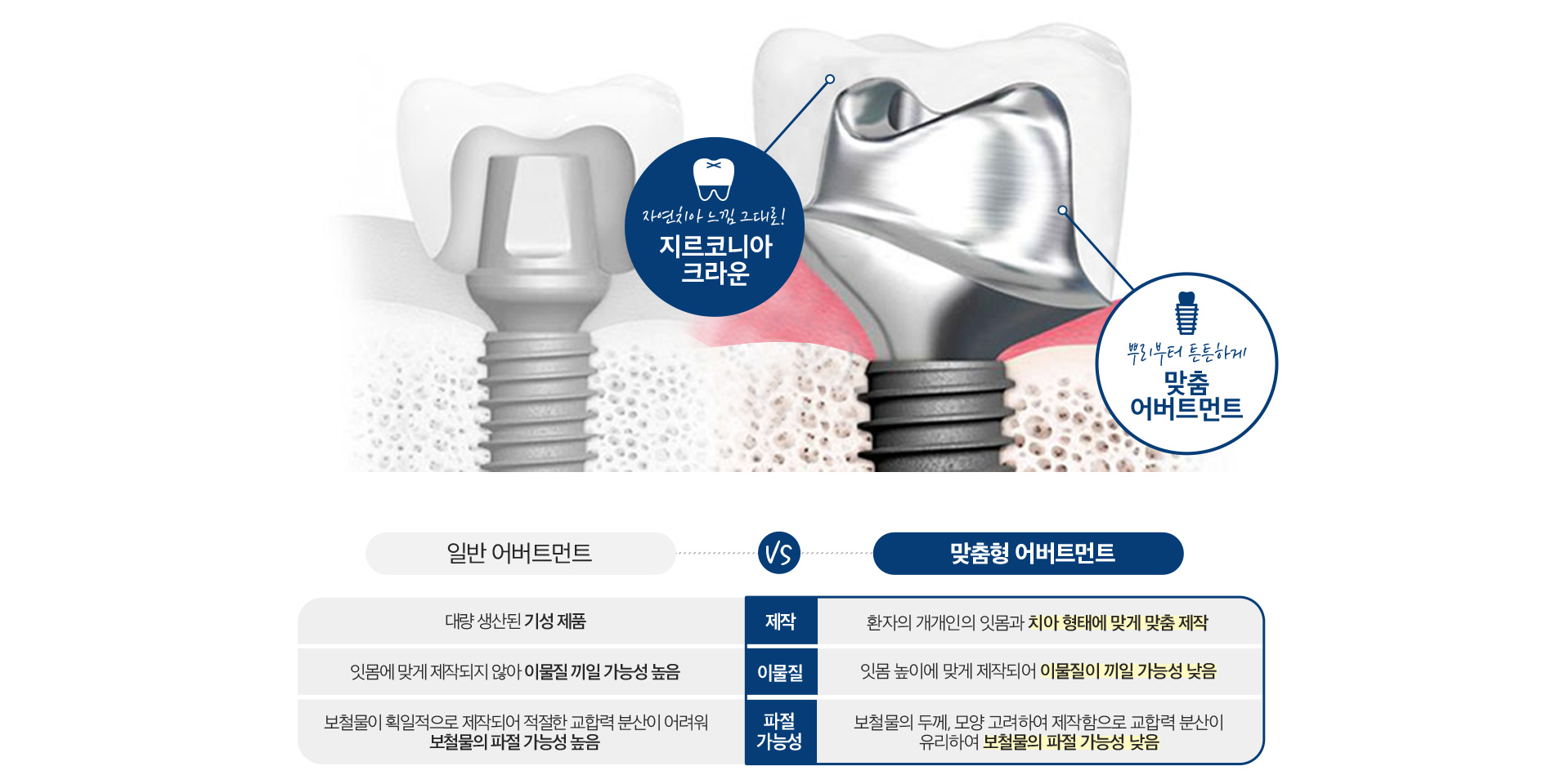 맞춤형 임플란트