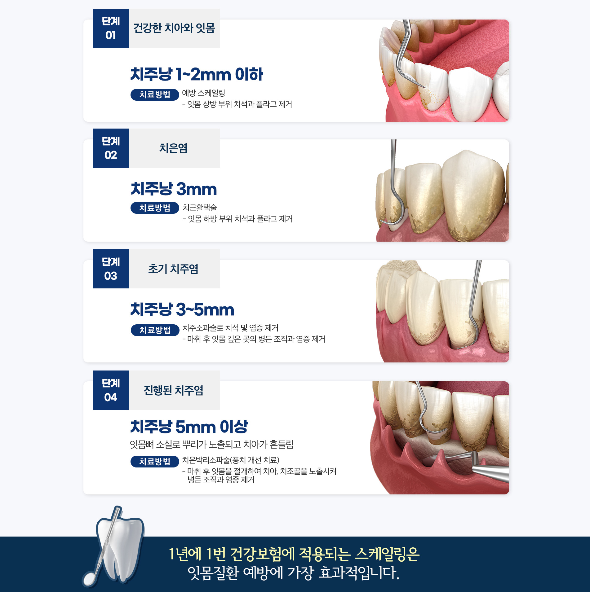 잇몸 상태 단계벌 치료방법
