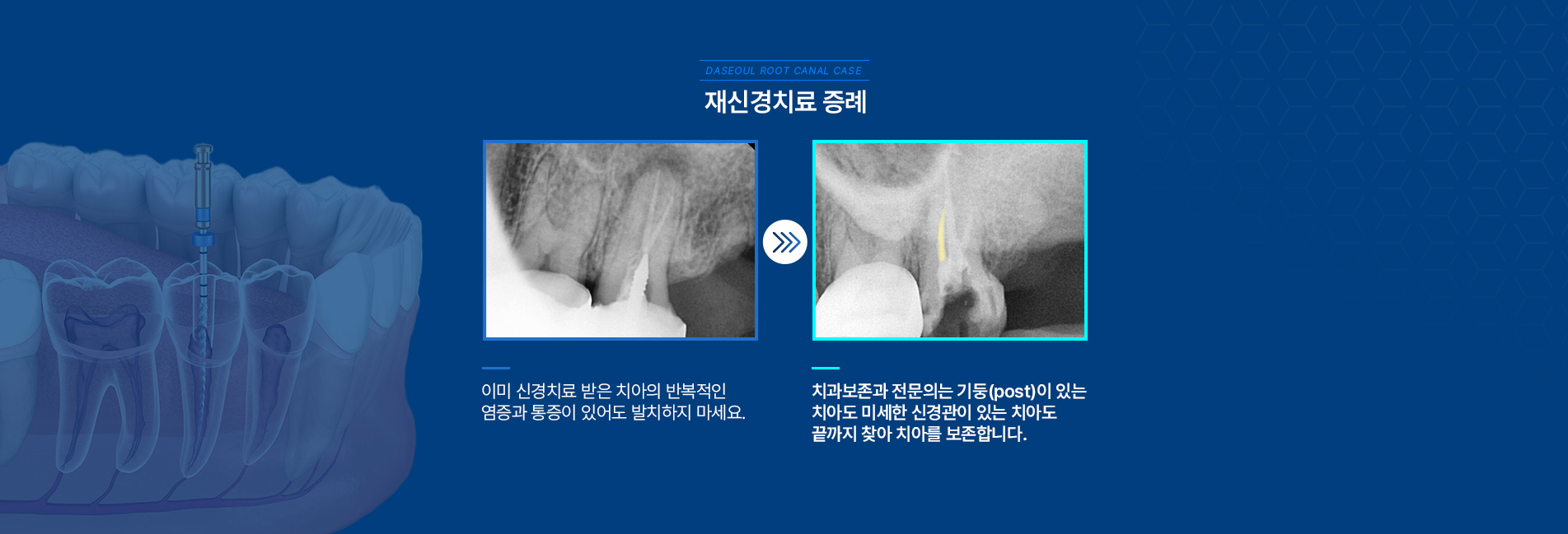 재신경치료 증례