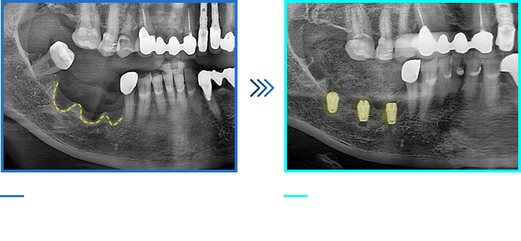뼈이식 임플란트 케이스01