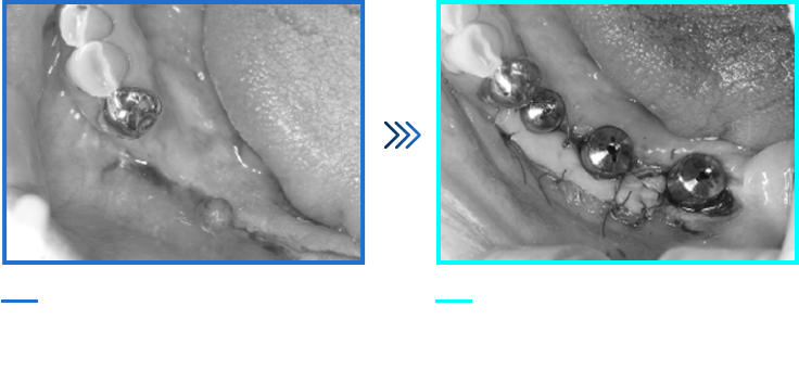 뼈이식 임플란트 케이스02
