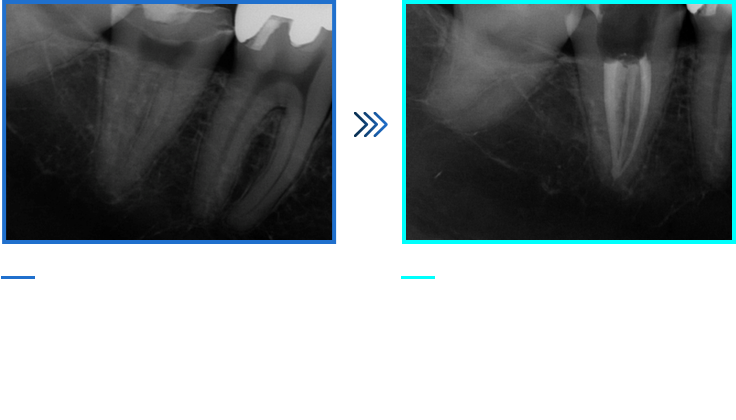 기형치아 신경치료 증례01
