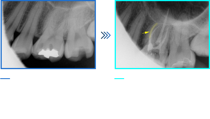 기형치아 신경치료 증례02